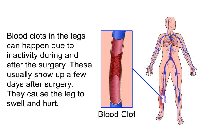 Blood clots in the legs can happen due to inactivity during and after the surgery. These usually show up a few days after surgery. They cause the leg to swell and hurt.