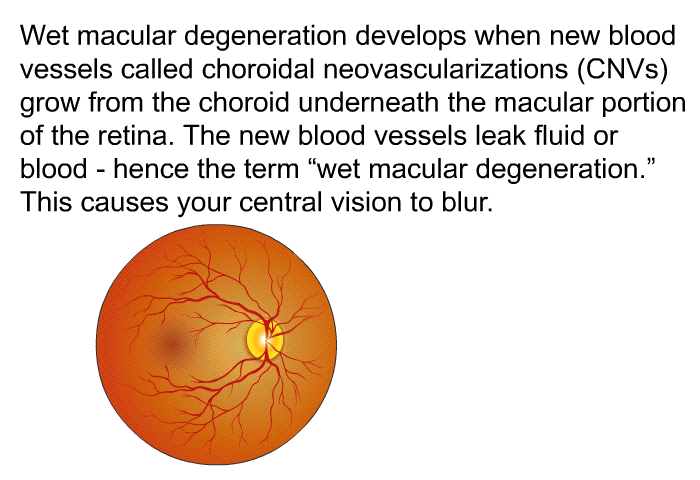 Wet macular degeneration develops when new blood vessels called choroidal neovascularizations (CNVs) grow from the choroid underneath the macular portion of the retina. The new blood vessels leak fluid or blood – hence the term “wet macular degeneration.” This causes your central vision to blur.