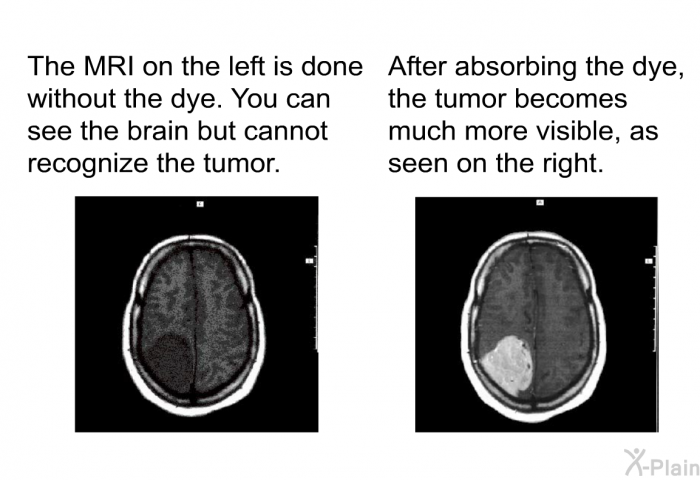 The MRI on the left is done without the dye. You can see the brain but cannot recognize the tumor. After absorbing the dye, the tumor becomes much more visible, as seen on the right.