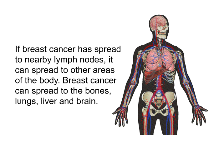 If breast cancer has spread to nearby lymph nodes, it can spread to other areas of the body. Breast cancer can spread to the bones, lungs, liver and brain.