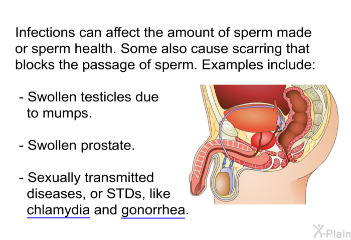 Infections can affect the amount of sperm made or sperm health. Some also cause scarring that blocks the passage of sperm. Examples include:  Swollen testicles due to mumps. Swollen prostate. Sexually transmitted diseases, or STDs, like chlamydia and gonorrhea.