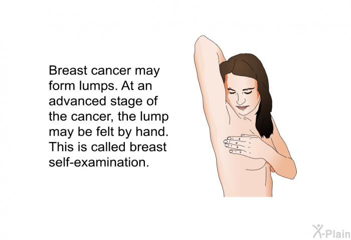 Breast cancer may form lumps. At an advanced stage of the cancer, the lump may be felt by hand. This is called breast self-examination.