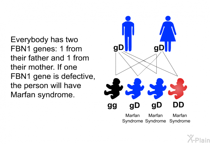 Everybody has two FBN1 genes: 1 from their father and 1 from their mother. If one FBN1 gene is defective, the person will have Marfan syndrome.