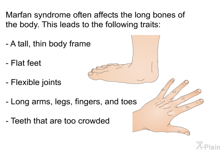 Marfan syndrome often affects the long bones of the body. This leads to the following traits:  A tall, thin body frame Flat feet Flexible joints Long arms, legs, fingers, and toes Teeth that are too crowded