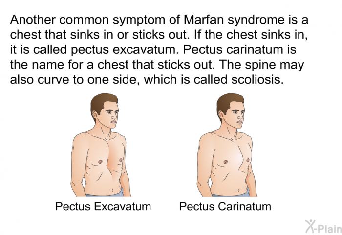 Another common symptom of Marfan syndrome is a chest that sinks in or sticks out. If the chest sinks in, it is called pectus excavatum. Pectus carinatum is the name for a chest that sticks out. The spine may also curve to one side, which is called scoliosis.