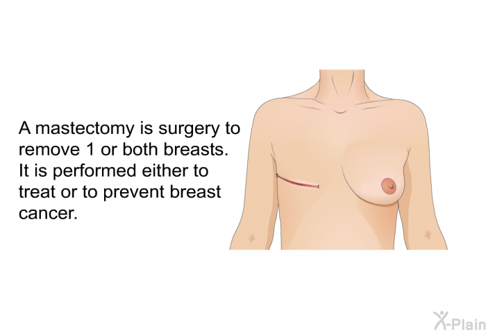 A mastectomy is surgery to remove 1 or both breasts. It is performed either to treat or to prevent breast cancer.