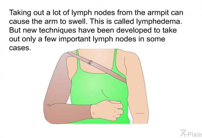 Taking out a lot of lymph nodes from the armpit can cause the arm to swell. This is called lymphedema. But new techniques have been developed to take out only a few important lymph nodes in some cases.