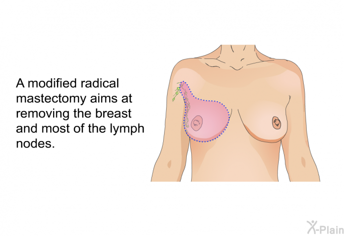 A modified radical mastectomy aims at removing the breast and most of the lymph nodes.