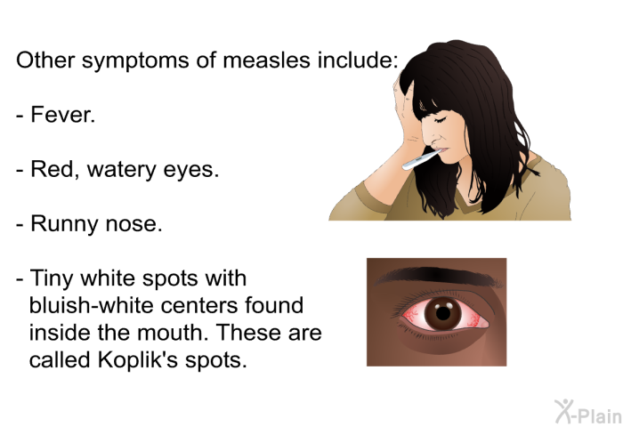 Other symptoms of measles include:  Fever. Red, watery eyes. Runny nose. Tiny white spots with bluish-white centers found inside the mouth. These are called Koplik's spots.