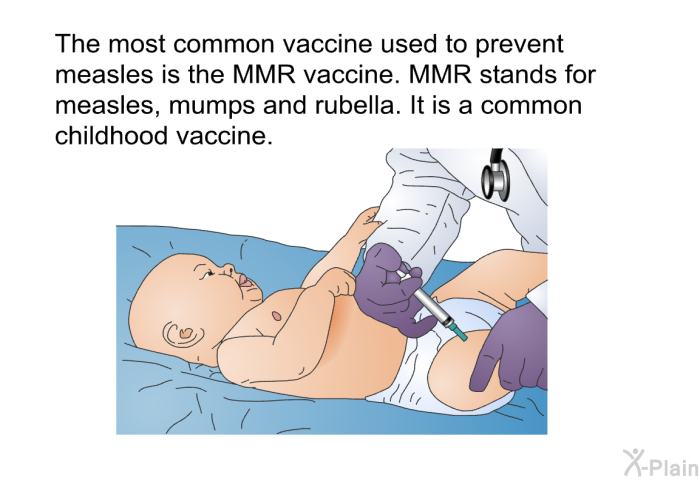 The most common vaccine used to prevent measles is the MMR vaccine. MMR stands for measles, mumps and rubella. It is a common childhood vaccine.