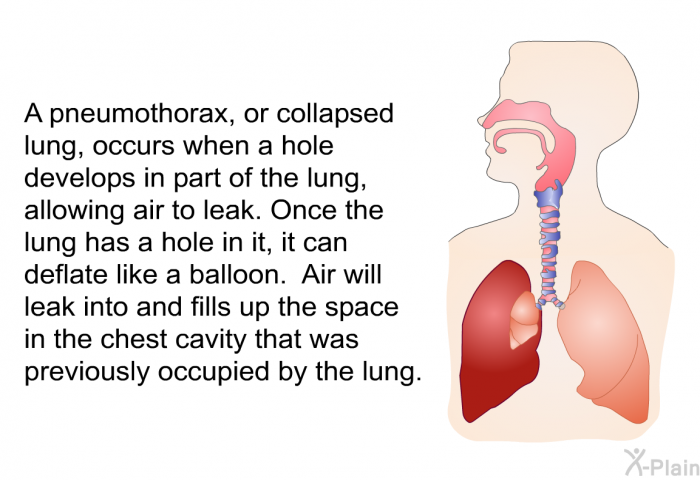 A pneumothorax, or collapsed lung, occurs when a hole develops in part of the lung, allowing air to leak. Once the lung has a hole in it, it can deflate like a balloon. Air will leak into and fills up the space in the chest cavity that was previously occupied by the lung.