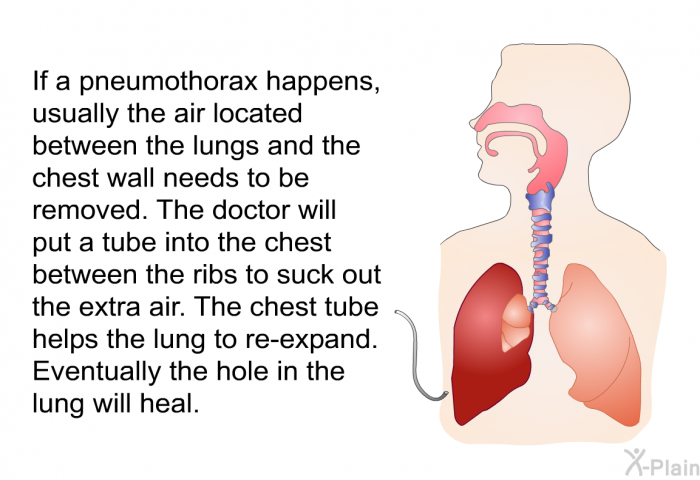 If a pneumothorax happens, usually the air located between the lungs and the chest wall needs to be removed. The doctor will put a tube into the chest between the ribs to suck out the extra air. The chest tube helps the lung to re-expand. Eventually the hole in the lung will heal.