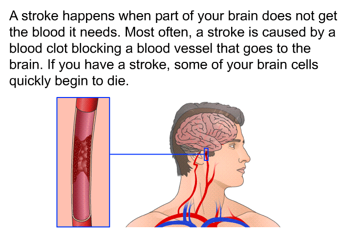 A stroke happens when part of your brain does not get the blood it needs. Most often, a stroke is caused by a blood clot blocking a blood vessel that goes to the brain. If you have a stroke, some of your brain cells quickly begin to die.