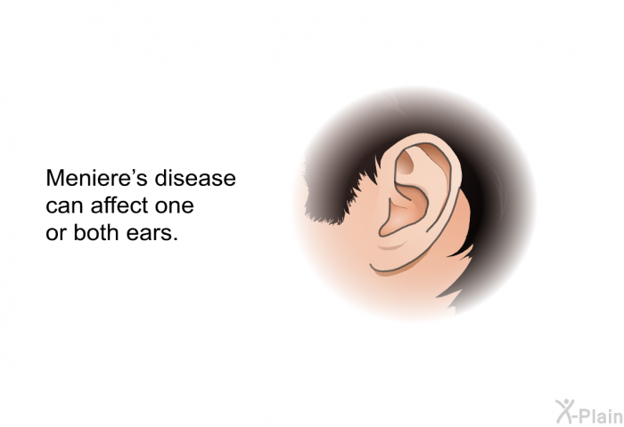 Meniere's disease can affect one or both ears.