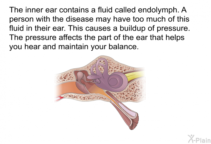 The inner ear contains a fluid called endolymph. A person with the disease may have too much of this fluid in their ear. This causes a buildup of pressure. The pressure affects the part of the ear that helps you hear and maintain your balance.