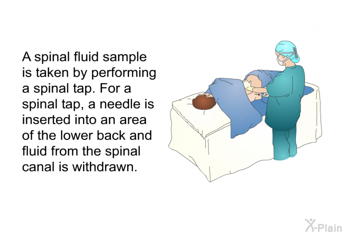 A spinal fluid sample is taken by performing a spinal tap. For a spinal tap, a needle is inserted into an area of the lower back and fluid from the spinal canal is withdrawn.