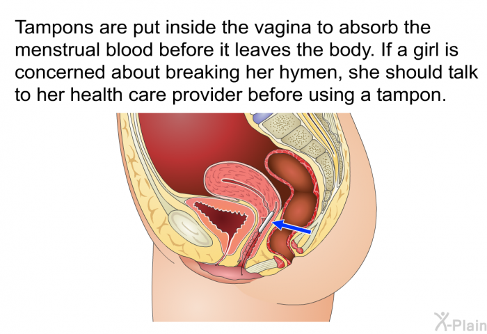 Tampons are put inside the vagina to absorb the menstrual blood before it leaves the body. If a girl is concerned about breaking her hymen, she should talk to her health care provider before using a tampon.