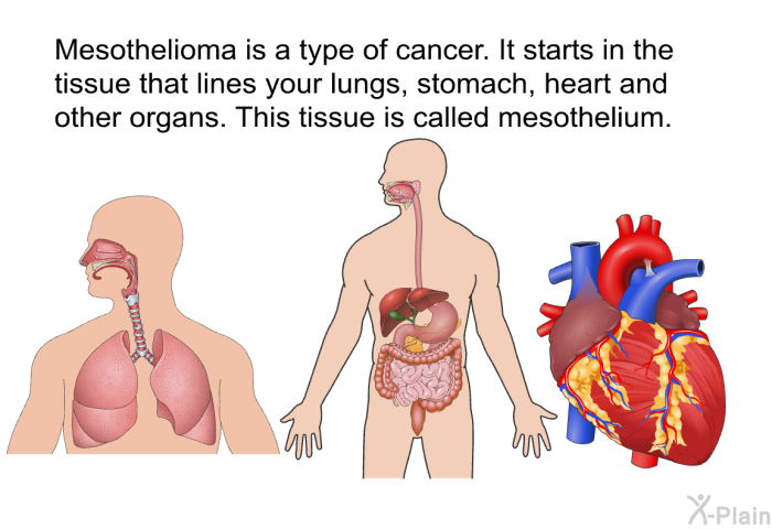 Mesothelioma is a type of cancer. It starts in the tissue that lines your lungs, stomach, heart and other organs. This tissue is called mesothelium.