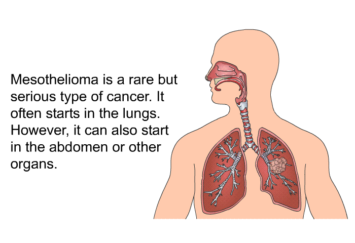 Mesothelioma is a rare but serious type of cancer. It often starts in the lungs. However, it can also start in the abdomen or other organs.