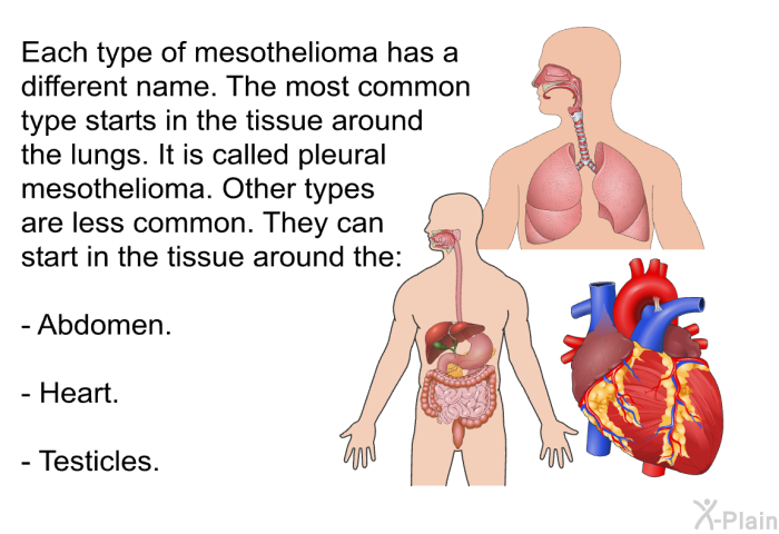 Each type of mesothelioma has a different name. The most common type starts in the tissue around the lungs. It is called pleural mesothelioma. Other types are less common. They can start in the tissue around the:  Abdomen. Heart. Testicles.