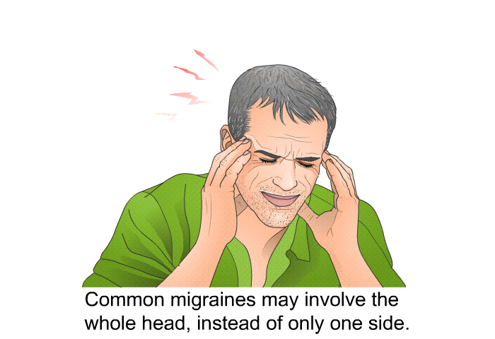 Common migraines may involve the whole head, instead of only one side.