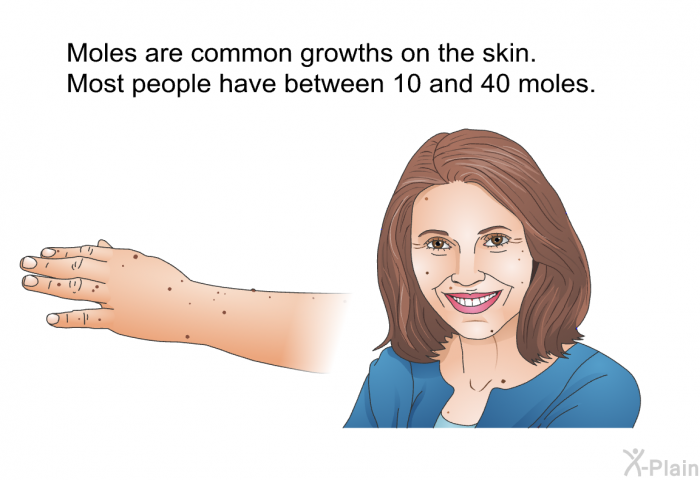 Moles are common growths on the skin. Most people have between 10 and 40 moles.