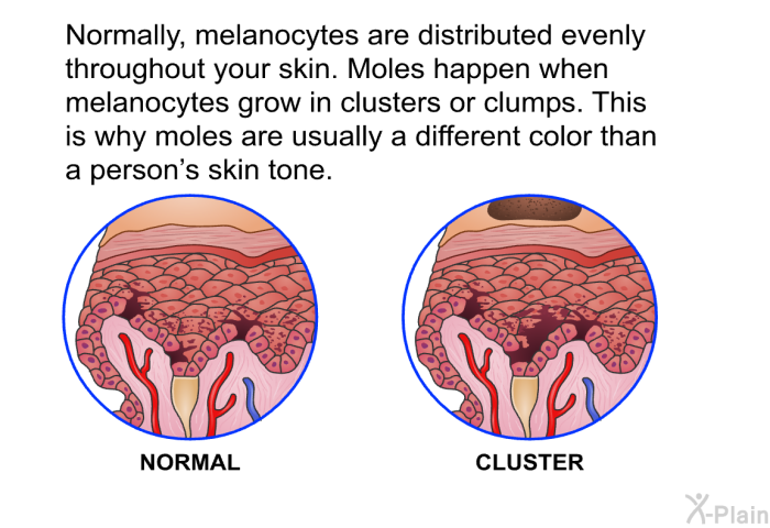 Normally, melanocytes are distributed evenly throughout your skin. Moles happen when melanocytes grow in clusters or clumps. This is why moles are usually a different color than a person's skin tone.