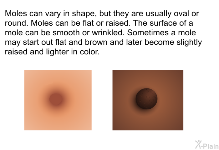 Moles can vary in shape, but they are usually oval or round. Moles can be flat or raised. The surface of a mole can be smooth or wrinkled. Sometimes a mole may start out flat and brown and later become slightly raised and lighter in color.