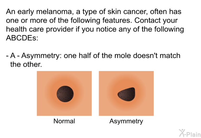 An early melanoma, a type of skin cancer, often has one or more of the following features. Contact your health care provider if you notice any of the following <B>ABCDEs:</B>  <B>A - Asymmetry:</B> one half of the mole doesn't match the other.