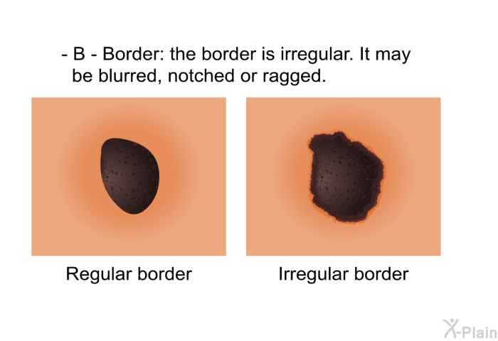 <B>B - Border:</B> the border is irregular. It may be blurred, notched or ragged.