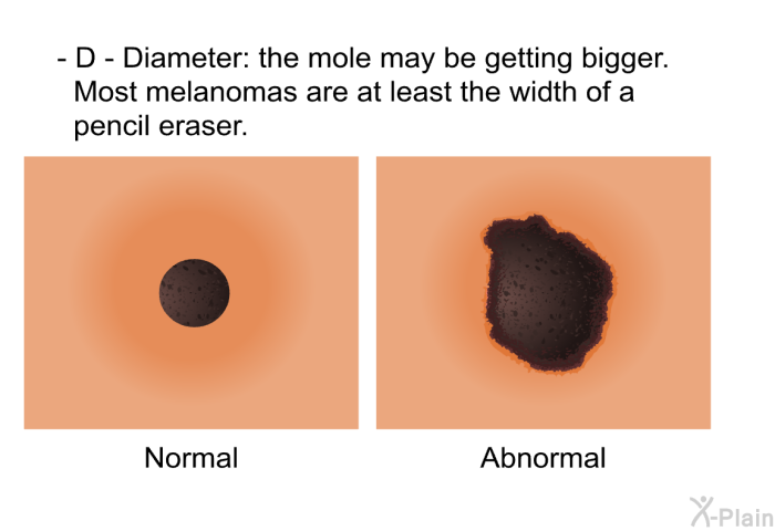 <B>D - Diameter:</B> the mole may be getting bigger. Most melanomas are at least the width of a pencil eraser.