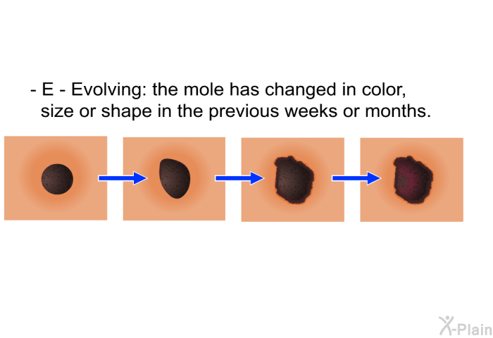 <B>E - Evolving:</B> the mole has changed in color, size or shape in the previous weeks or months.