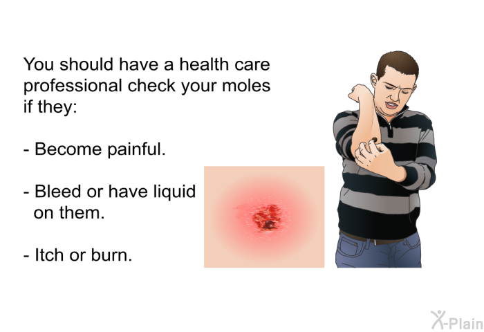 You should have a health care professional check your moles if they:  Become painful. Bleed or have liquid on them. Itch or burn.
