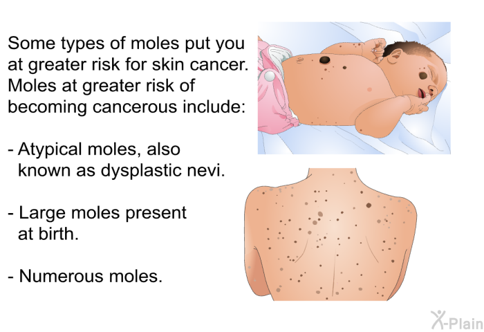 Some types of moles put you at greater risk for skin cancer. Moles at greater risk of becoming cancerous include:  Atypical moles, also known as dysplastic nevi. Large moles present at birth. Numerous moles.