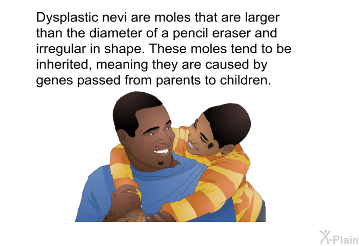 Dysplastic nevi are moles that are larger than the diameter of a pencil eraser and irregular in shape. These moles tend to be inherited, meaning they are caused by genes passed from parents to children.
