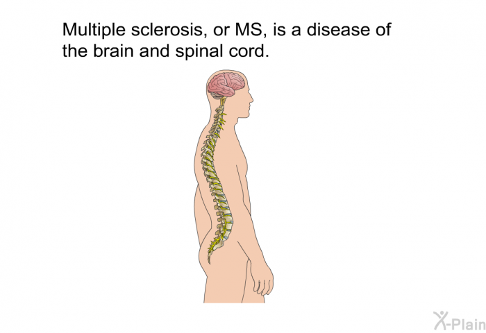 Multiple sclerosis, or MS, is a disease of the brain and spinal cord.