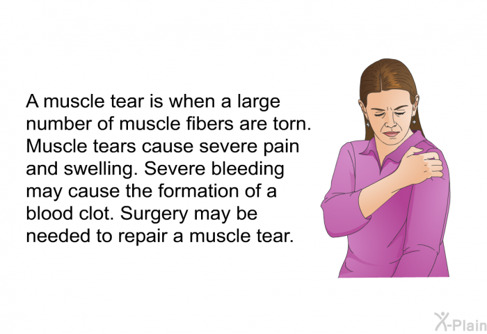 A muscle tear is when a large number of muscle fibers are torn. Muscle tears cause severe pain and swelling. Severe bleeding may cause the formation of a blood clot. Surgery may be needed to repair a muscle tear.
