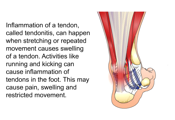 Inflammation of a tendon, called tendonitis, can happen when stretching or repeated movement causes swelling of a tendon. Activities like running and kicking can cause inflammation of tendons in the foot. This may cause pain, swelling and restricted movement.