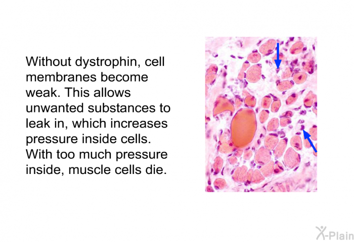 Without dystrophin, cell membranes become weak. This allows unwanted substances to leak in, which increases pressure inside cells. With too much pressure inside, muscle cells die.