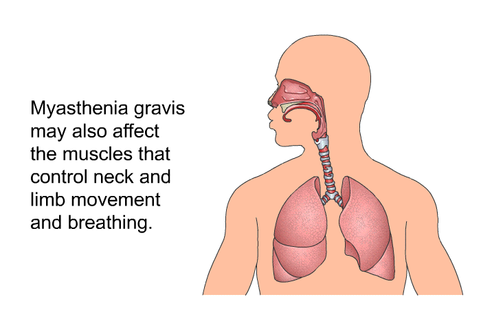 Myasthenia gravis may also affect the muscles that control neck and limb movement and breathing.