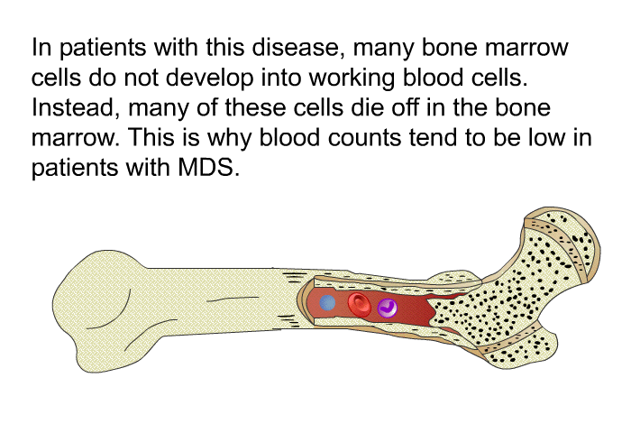 In patients with this disease, many bone marrow cells do not develop into working blood cells. Instead, many of these cells die off in the bone marrow. This is why blood counts tend to be low in patients with MDS.