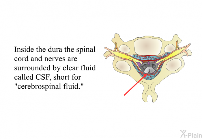 Inside the dura the spinal cord and nerves are surrounded by clear fluid called CSF, short for "cerebrospinal fluid."