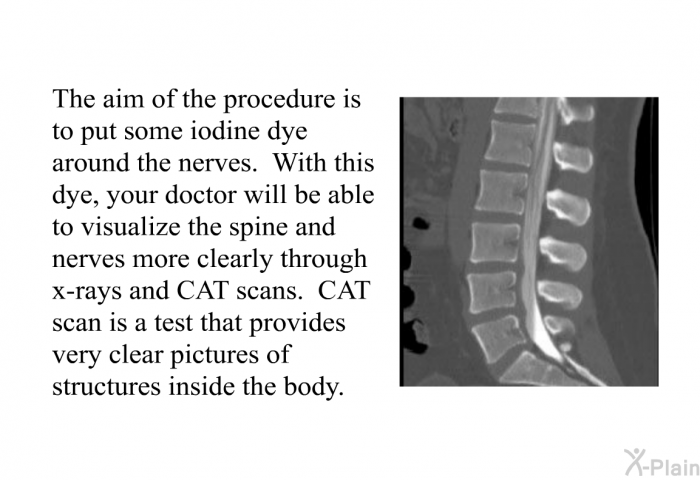 The aim of the procedure is to put some iodine dye around the nerves. With this dye, your doctor will be able to visualize the spine and nerves more clearly through x-rays and CAT scans. CAT scan is a test that provides very clear pictures of structures inside the body.