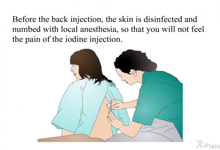 Before the back injection, the skin is disinfected and numbed with local anesthesia, so that you will not feel the pain of the iodine injection.