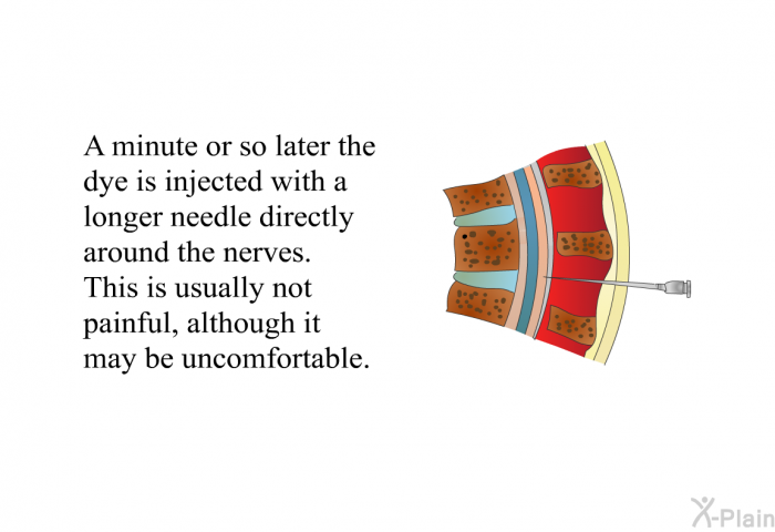 A minute or so later the dye is injected with a longer needle directly around the nerves. This is usually not painful, although it may be uncomfortable.