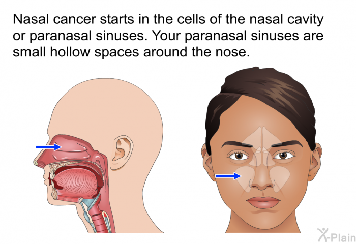 Nasal cancer starts in the cells of the nasal cavity or paranasal sinuses. Your paranasal sinuses are small hollow spaces around the nose.