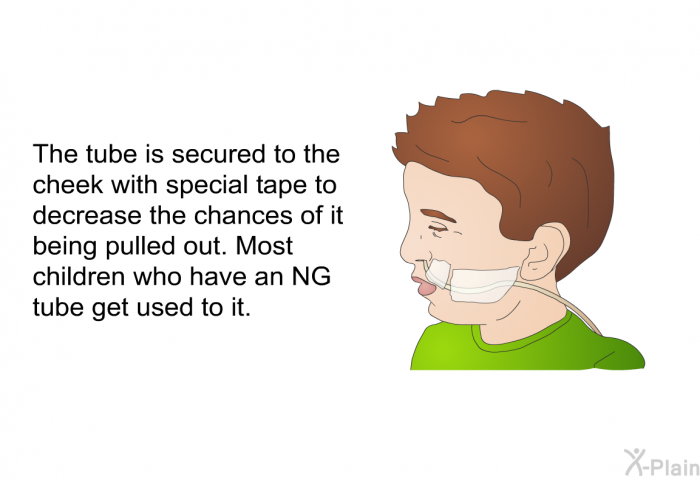 The tube is secured to the cheek with special tape to decrease the chances of it being pulled out. Most children who have an NG tube get used to it.
