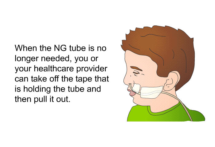 When the NG tube is no longer needed, you or your healthcare provider can take off the tape that is holding the tube and then pull it out.