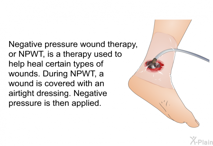 Negative pressure wound therapy, or NPWT, is a therapy used to help heal certain types of wounds. During NPWT, a wound is covered with an airtight dressing. Negative pressure is then applied.