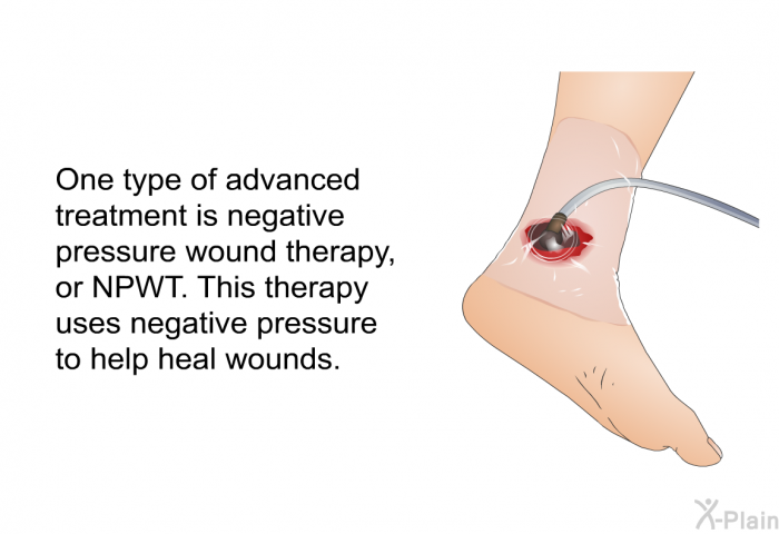One type of advanced treatment is negative pressure wound therapy, or NPWT. This therapy uses negative pressure to help heal wounds.